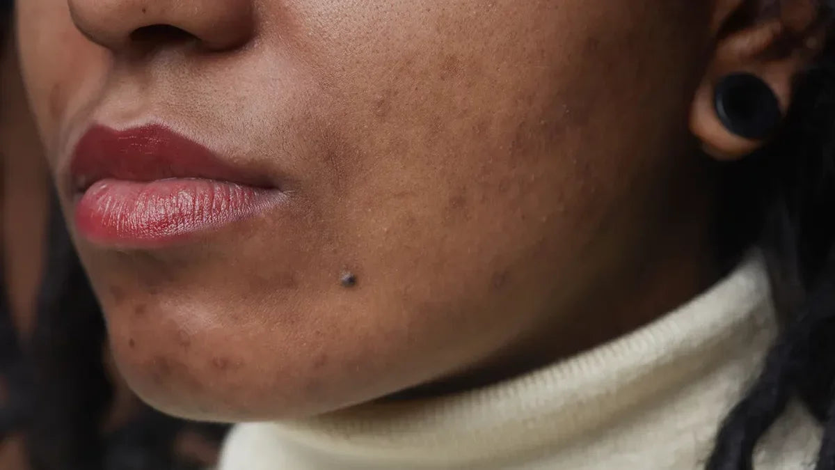 Acné sur peau noire : boutons, taches post-acné et routine adaptée Image