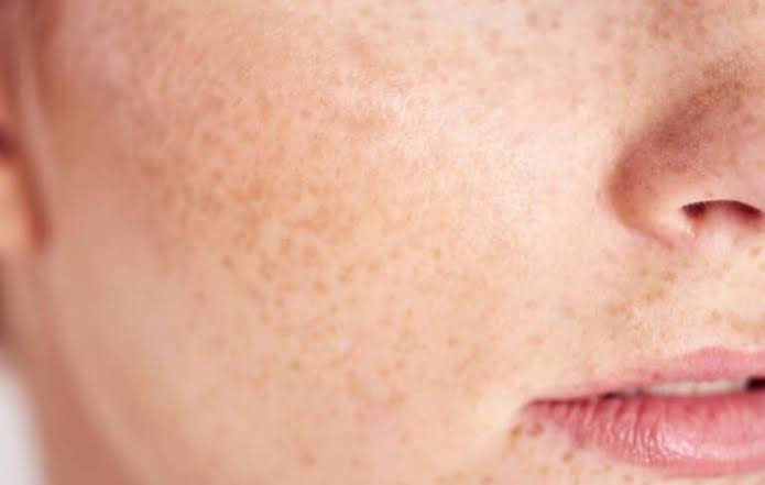 Taches après les boutons ou cicatrices d’acné : comment les différencier ? Image