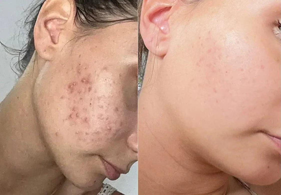 Curcuma et hyperpigmentation : comment agit-il vraiment sur les taches brunes ? Imagen