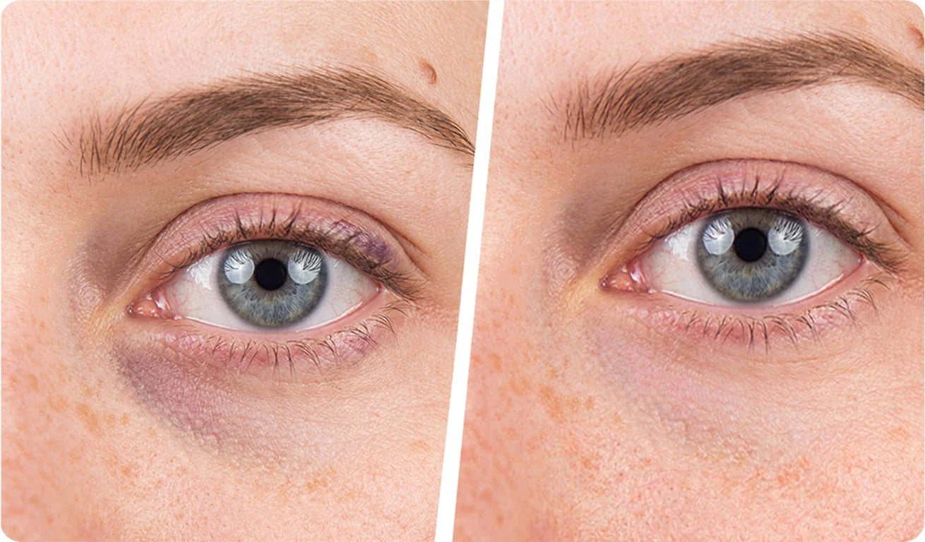 Patch yeux réutilisable ou à usage unique : lequel choisir ?